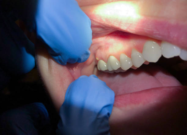 Best Emergency Care for Gum Disease in Port Huron, MI
